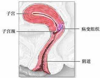 子宫颈炎症 子宫颈炎症 子宫炎症严重吗 女人怎样预防子宫炎症