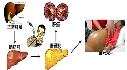 肝癌早期症状有哪些 肝癌早期症状有哪些 肝癌的早期症状都有哪些