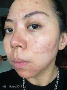 如何快速消除额头痘痘 怎样快速解决额头的痘痘
