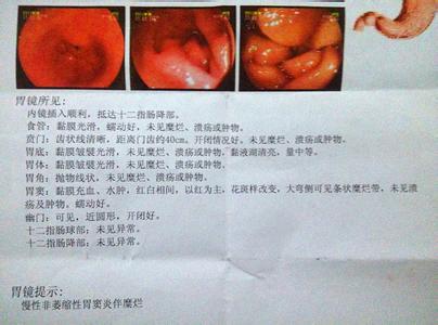 慢性非萎缩性胃窦炎 慢性胃窦炎 慢性胃窦炎是怎样的疾病