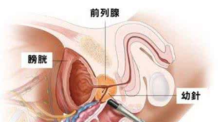 慢性前列腺炎吃什么好 慢性前列腺炎的治疗 前列腺炎吃什么好