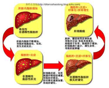 脂肪肝会引起肝癌吗 脂肪肝发病率 脂肪肝引起的肝癌发病率增高