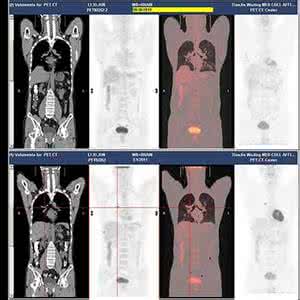 日本骨髓注射增高 petct 骨髓普遍性增高 北京水果价格行情介绍 今夏水果价格增高普遍