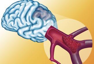 中风前的征兆 易被误读的中风征兆