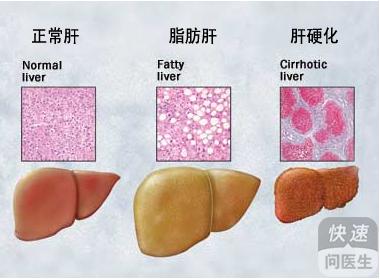 肝癌早期治疗方法 肝癌的早期症状 肝癌有哪些治疗方法