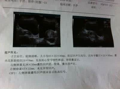 b超要多久能查出怀孕 怀孕多久可以做b超看出来