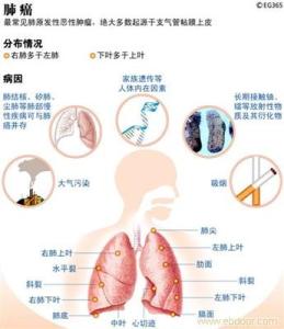 肺癌脑转移放疗 肺癌脑转移放疗 肺癌脑转移放疗效果如何