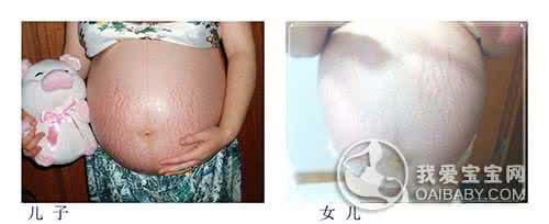 妊娠线能预测生男生女 妊娠线 妊娠线能预测生男生女 这是真的吗?