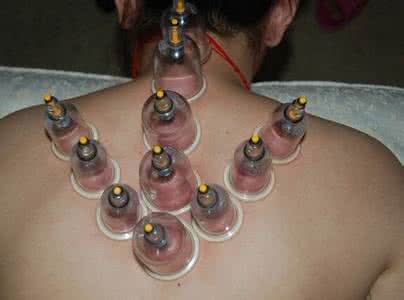 拔火罐能治颈椎病 拔火罐能治颈椎病 拔火罐治颈椎病的作用