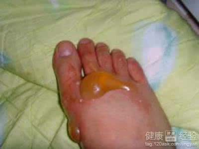 烫伤的水泡要不要弄破 烫伤后的水泡要弄破么 烫伤后水泡怎么处理