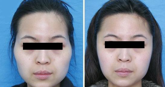 窄额头变宽自然疗法 额头变宽 怎样使额头变宽?