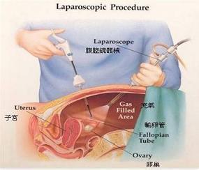 宫外孕治疗后怎样保养 宫外孕治疗 怎样治疗宫外孕
