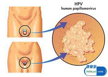 包皮尖锐湿疣怎么治疗 尖锐湿疣主要治疗方式
