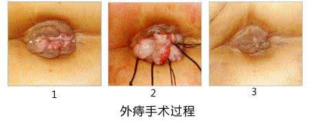 怎么治痔疮最快有简单 痔疮怎么治