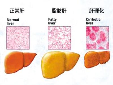 高血脂与脂肪肝 脂肪肝，不全与脂肪有关