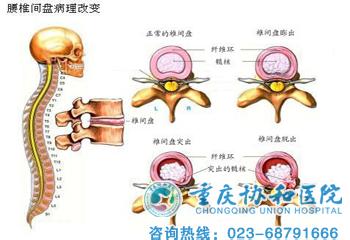 腰椎盘膨出治疗方法 腰椎盘膨出治疗方法 怎么治疗腰椎盘膨出