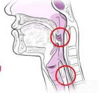 吞咽困难就是食道癌吗 男子将手机吞入食道 哪些东西容易误入食道