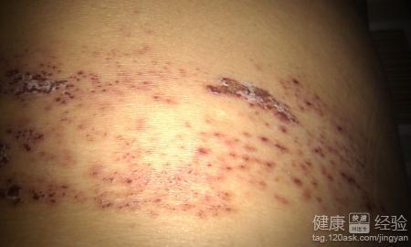 专治带状疱疹 家传秘方：专治‘带状疱疹’疗效佳！