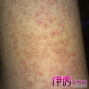尘螨过敏性皮炎 尘螨过敏性皮炎 冬季空调内尘螨 可能引发过敏性皮炎