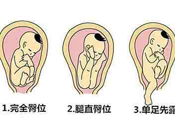 胎位不正臀位纠正图 胎位臀位的危害