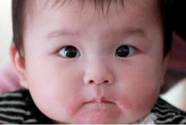 婴儿湿疹反复发作原因 湿疹反复发作 防止婴儿湿疹反复的饮食规矩有哪些