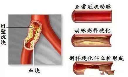 血管里的油 血管里的”油“（中）