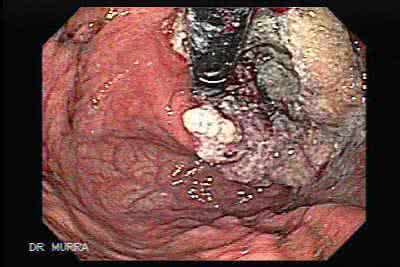 贲门癌晚期治疗小偏方 贲门癌晚期治疗小偏方 贲门癌偏方