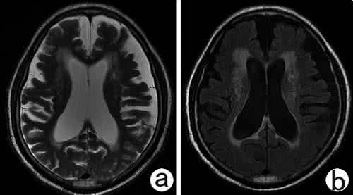 脑白质脱髓鞘改变症状 脑白质脱髓鞘改变 它的症状起因是什么