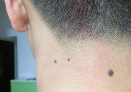 后背长痣长痣相图解 后背长痣长痣相图解 身上长痣好不好