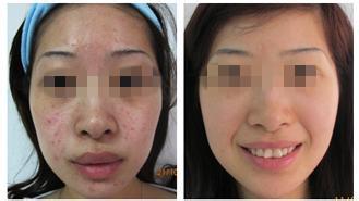 激光祛痘印多少钱 祛痘印 祛痘印多少钱