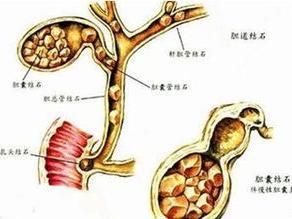 胆囊结石饮食禁忌 胆囊结石不能吃什么 胆囊结石的饮食禁忌
