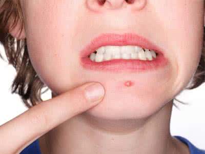 下巴两边怎么会张痘痘 下巴两边怎么会张痘痘 【下巴两边长痘痘】下巴长痘的原因和治疗方法?