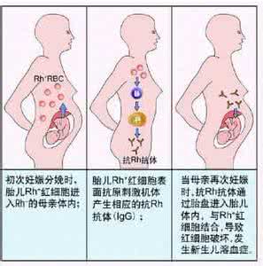 溶血性疾病的症状 新生儿溶血病 新生儿溶血病是怎么形成的