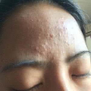 脸上长痘痘该怎么办 夏季长痘痘该怎么办