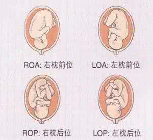 胎位roa是男孩女孩 胎位roa是什么意思