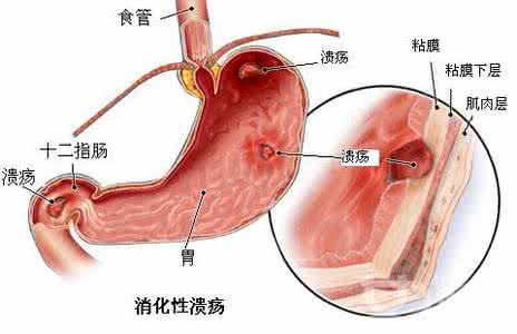 消化性溃疡怎么治？练习太极治疗效果很显著