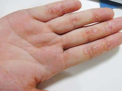 治疗湿疹效果好的医院 治疗湿疹 中医治湿疹效果好