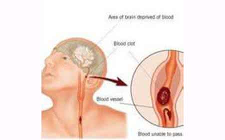肌张力异常的表现 七种异常表现 脑血栓前兆