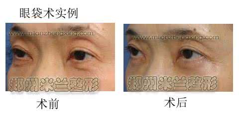 治疗眼袋的最好方法 去眼袋专家 去眼袋的方法哪种好 看专家介绍