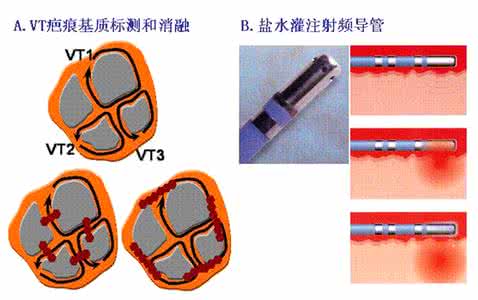 什么叫器质性心脏病 器质性心脏病 什么是器质性心脏病