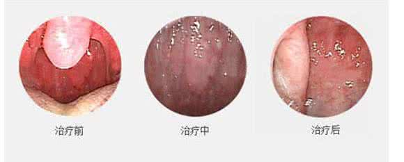 咽炎吃什么药效果最好 咽炎