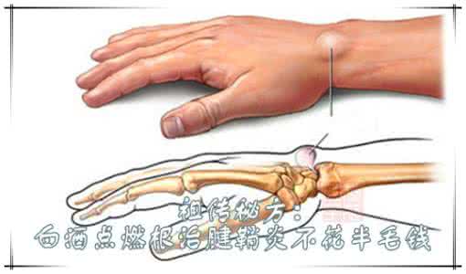 白酒治疗腱鞘炎 祖传秘方：白酒点燃根治腱鞘炎不花半毛钱