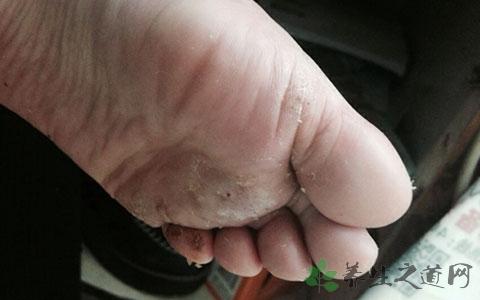 金达克宁能根治脚气吗 达克宁 脱皮脚气怎么根治？