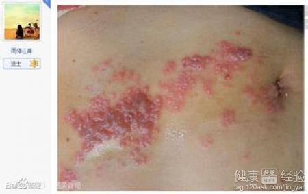 怎么治疗疱疹 疱疹 疱疹怎么治疗