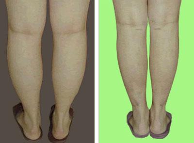 吸脂抽脂 小腿抽脂 小腿吸脂