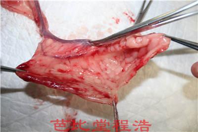 腹股沟疝病例 腹股沟疝病例（模板）