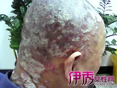 银屑病可以喝酒吗 银屑病可以治疗好吗 酒可以治疗银屑病吗？