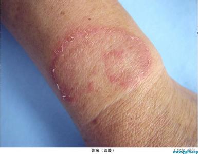 手指奇痒水泡偏方醋精 【西医偏方】彩图推荐《身上奇痒患湿疹，神水一摸就除根》