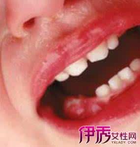 牙龈为什么会发炎 牙龈发炎 牙龈为什么会发炎