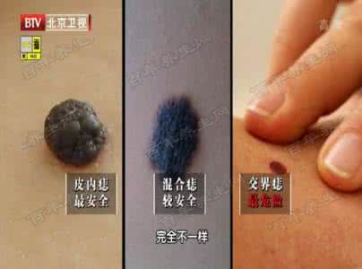 乙肝小三阳多久变肝癌 20151026X诊所视频和笔记:张玮,肝癌,乙肝,肝斑,肝硬化,蜘蛛痣